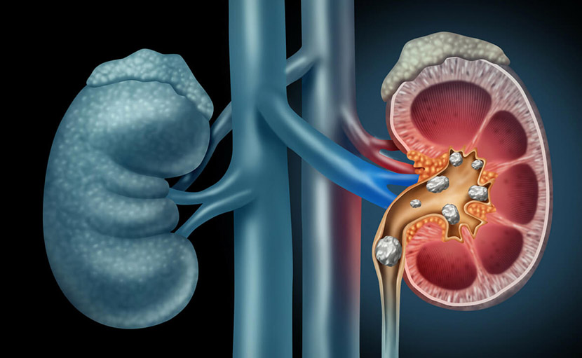 Kidney, Ureter & Bladder Stone Treatment